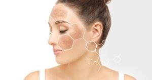 hyperpigmentation