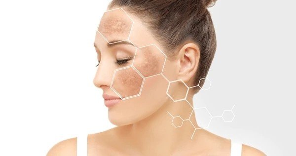 hyperpigmentation