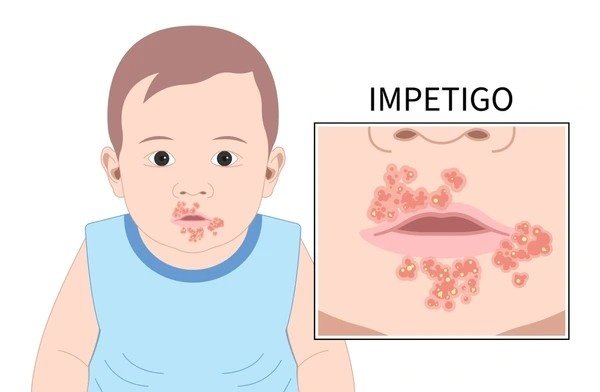 impetigo