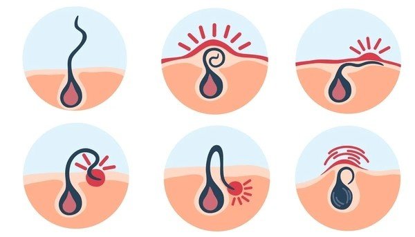 ingrown hair