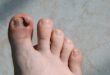 ingrown toenail