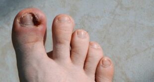 ingrown toenail