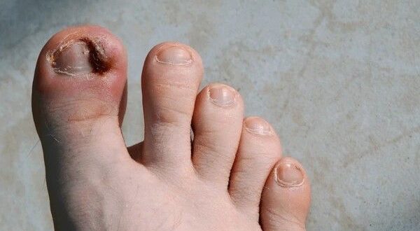 ingrown toenail