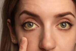 jaundice
