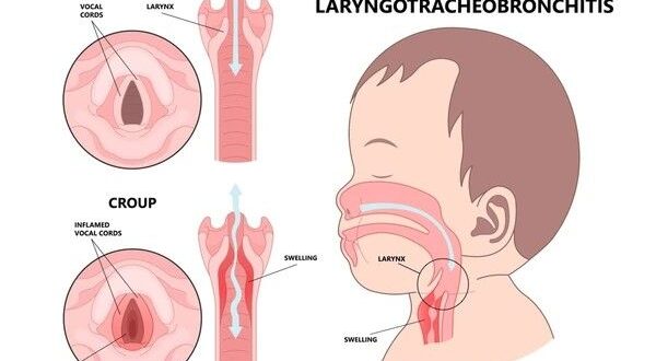 laryngitis