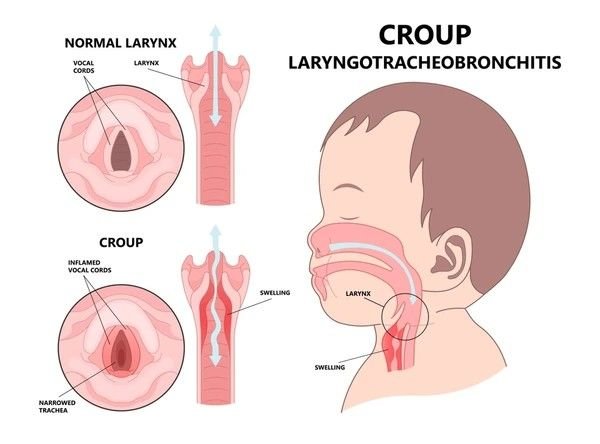 laryngitis