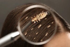 lice in hair