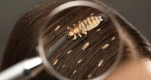 lice in hair