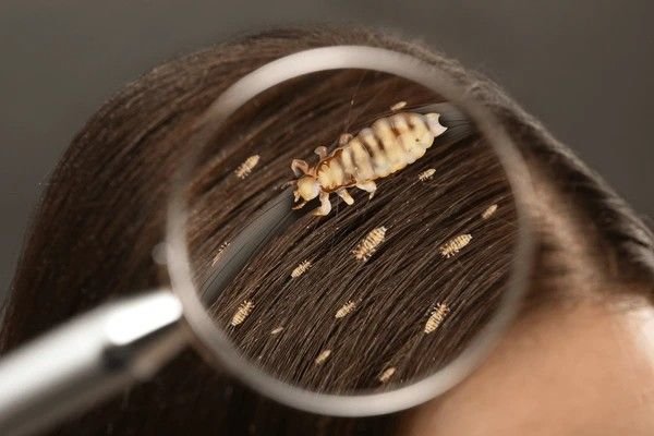 lice in hair