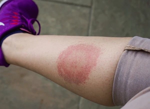 lyme disease