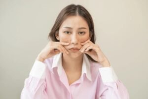melasma