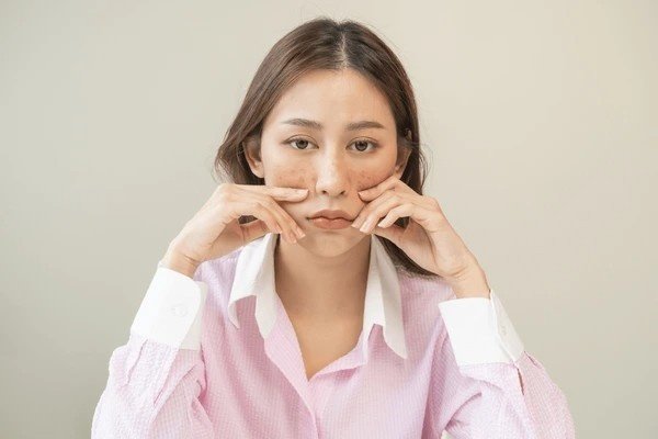 melasma