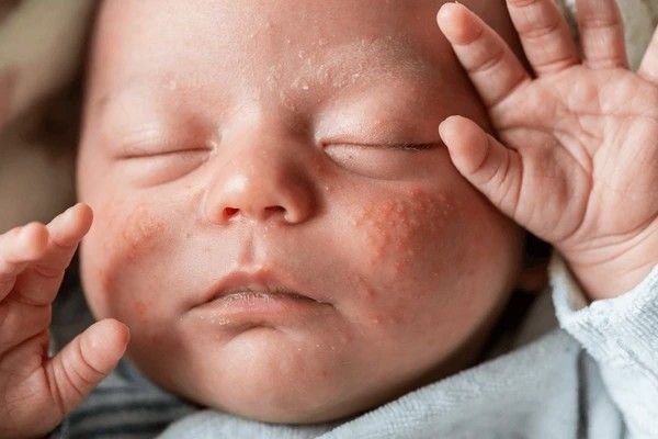 milia in infants