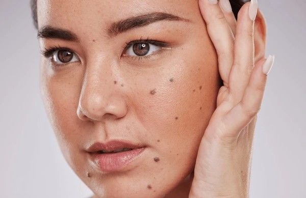 moles