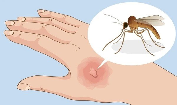 mosquito bites