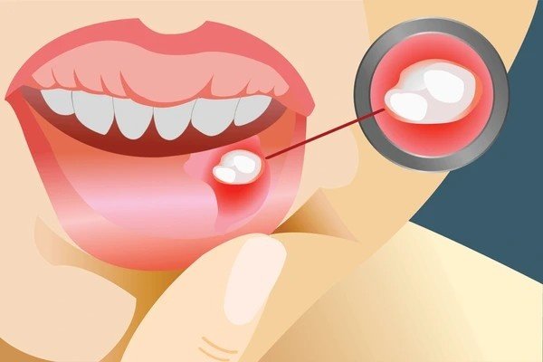 mouth ulcer
