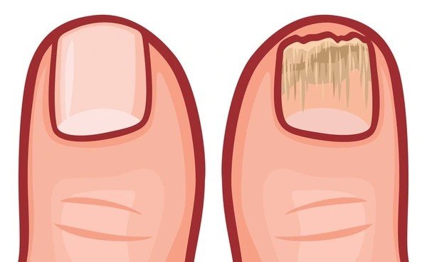 nail fungus