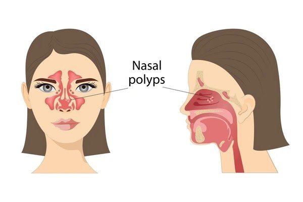 nasal polyps
