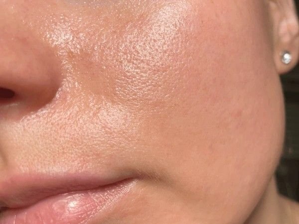 oily skin