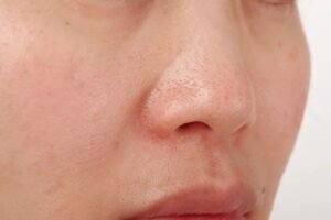 open pores