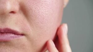 open pores on face