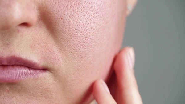 open pores on face