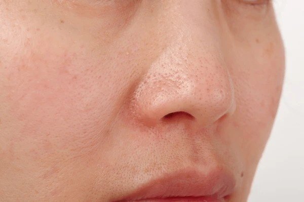 open pores