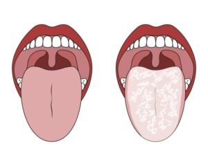 oral thrush