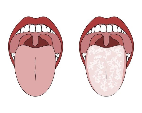 oral thrush