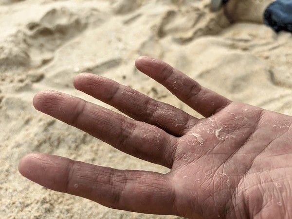 palm skin peeling