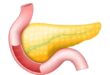 pancreatitis