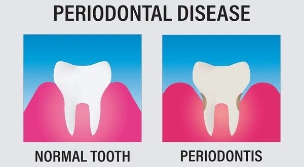 periodontal disease