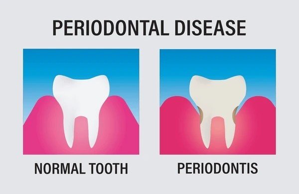 periodontal disease
