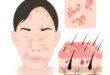 perioral dermatitis