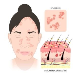 perioral dermatitis