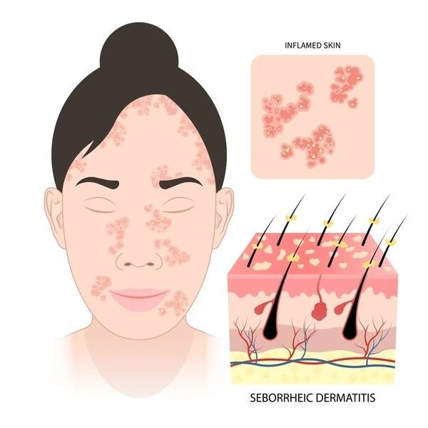 perioral dermatitis