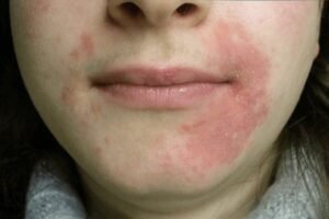 perioral dermatitis