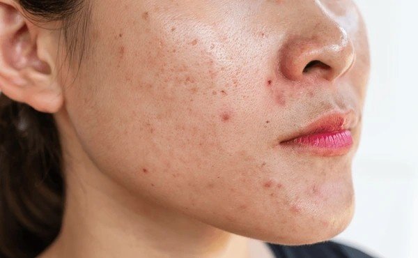 pimples for oily skin overnight