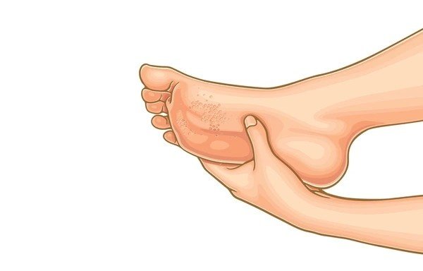 plantar warts