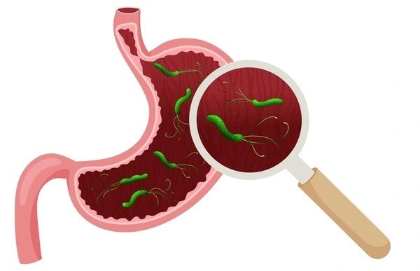 pylori