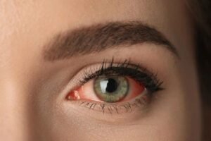 red eye