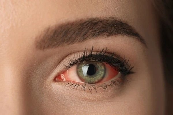 red eye