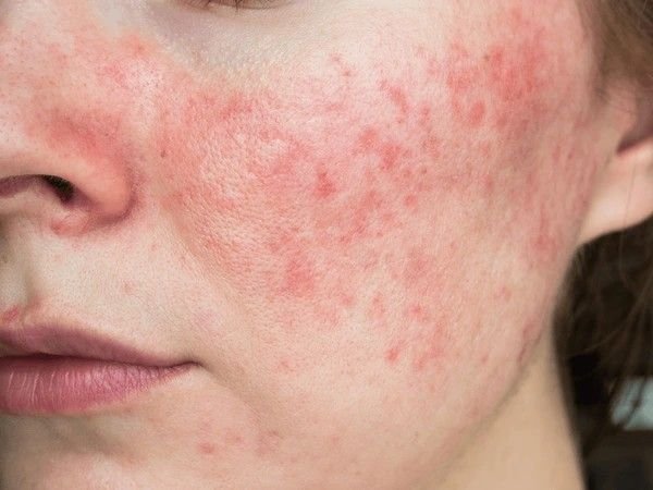 redness on face