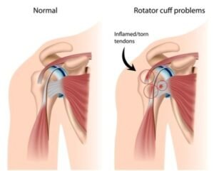 rotator cuff pain