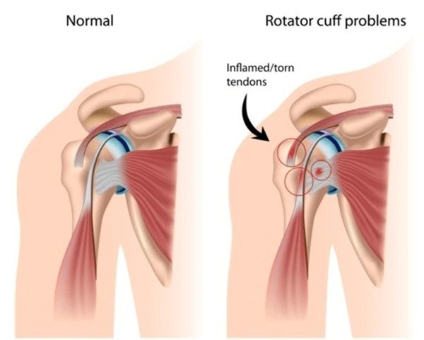 rotator cuff pain