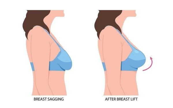 sagging breast