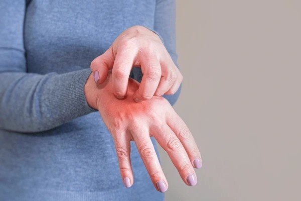 scabies