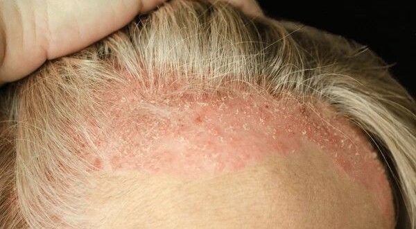 scalp psoriasis