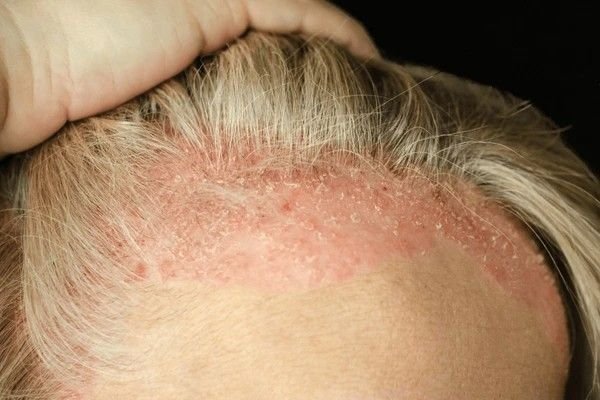 scalp psoriasis