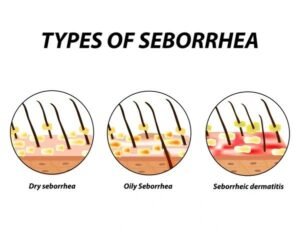 seborrheic dermatitis